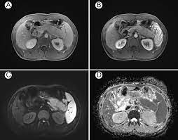 MRI ABDOMEN