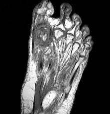 MRI FOREFOOT