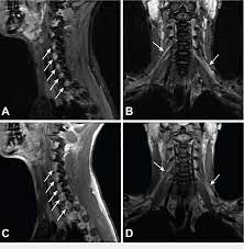 MRI BRACHIAL PLEXUS