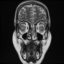 MR ANGIOGRAM HEAD/BRAIN