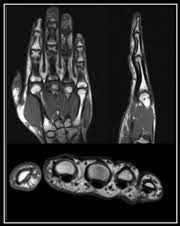 MRI HAND