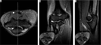 MRI ELBOW