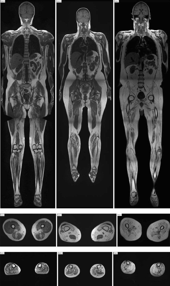 MRI FULL BODY HEAD/NECK/CHEST/ABDOMEN/PELVIS/SPINE