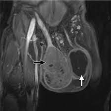 Scrotum and Phallus Magnetic Resonance Imaging (MRI)